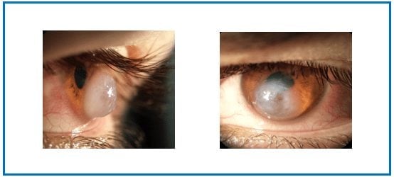 keratoconus cornea swelling