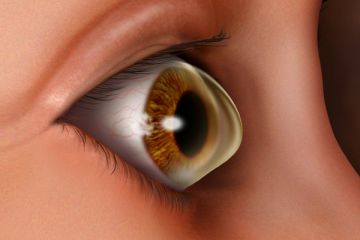 keratoconus eye