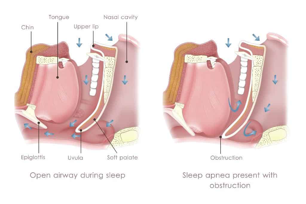 Obstructive Sleep Apnea in La Jolla, Del Mar, & Pacific Beach