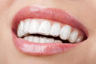 Invisalign for La Jolla, Del Mar, & Pacific Beach