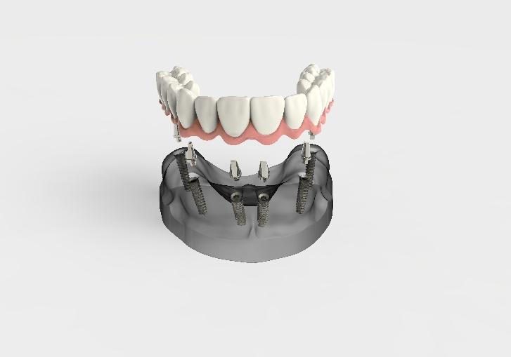 Implant Supported Dentures for La Jolla, Del Mar, & Pacific Beach