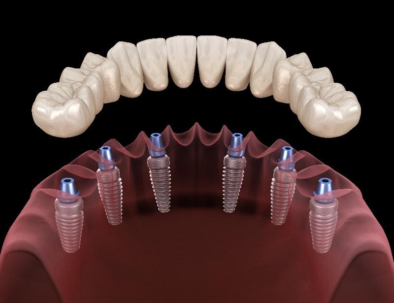 Dental Implants with Crowns or Bridges in La Jolla