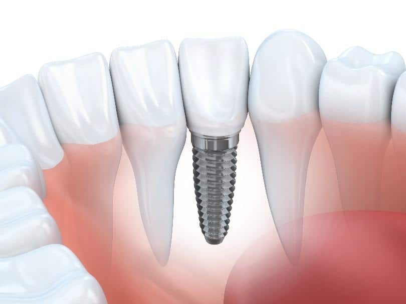 Dental Implants for La Jolla, Del Mar, & Pacific Beach