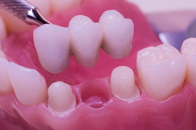 Dental Bridges for La Jolla, Del Mar, & Pacific Beach