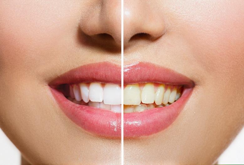 Teeth Whitening for La Jolla, Del Mar, & Pacific Beach