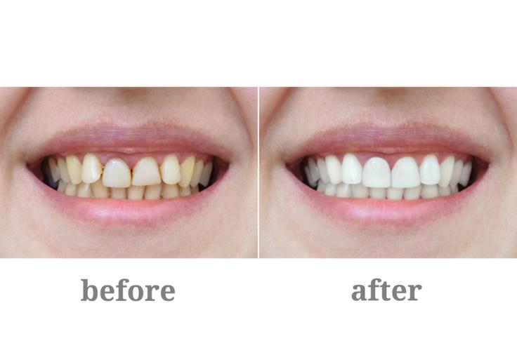 Smile Makeover for La Jolla, Del Mar, & Pacific Beach