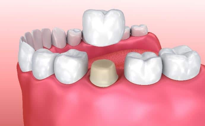 Tooth Crowns for San Diego