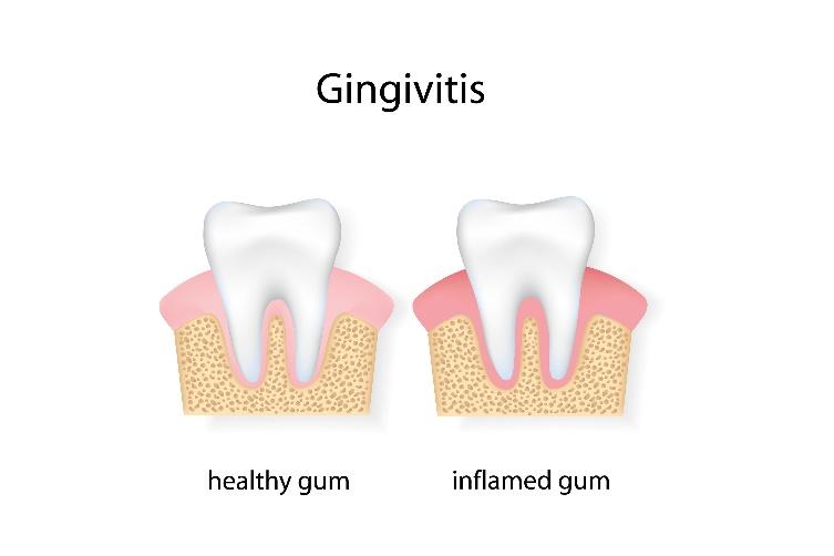 Periodontal Treatment for La Jolla, Del Mar, & Pacific Beach