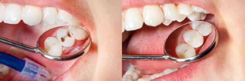 Tooth-Colored Fillings for La Jolla, Del Mar, & Pacific Beach