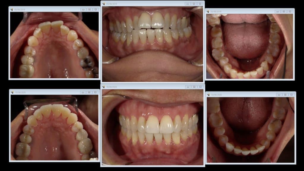 Invisalign Before After Photos at La Jolla Family Smile Design