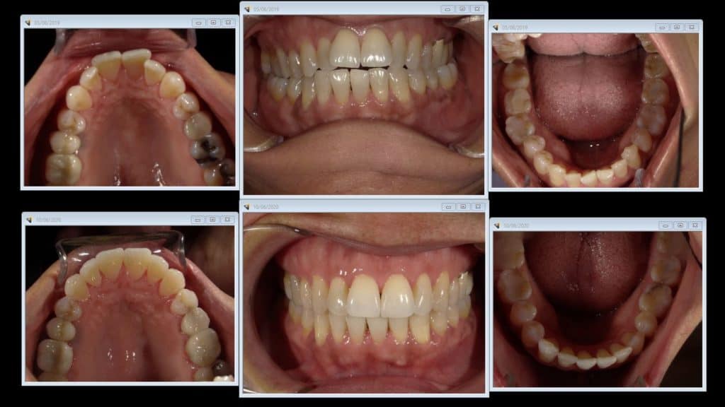 Invisalign First (Clear Plate Treatment in Children) - Dart Dental