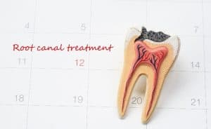 Root Canal for La Jolla, Del Mar, Pacific Beach