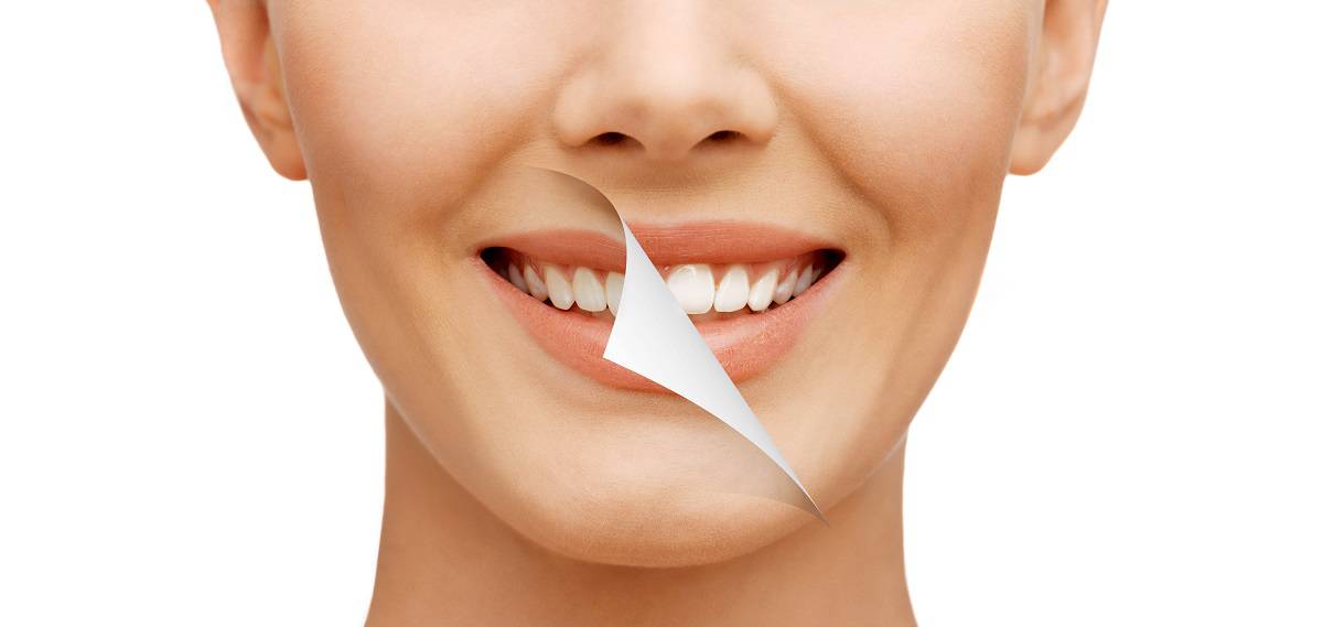 Teeth Whitening for a brighter smile in La Jolla