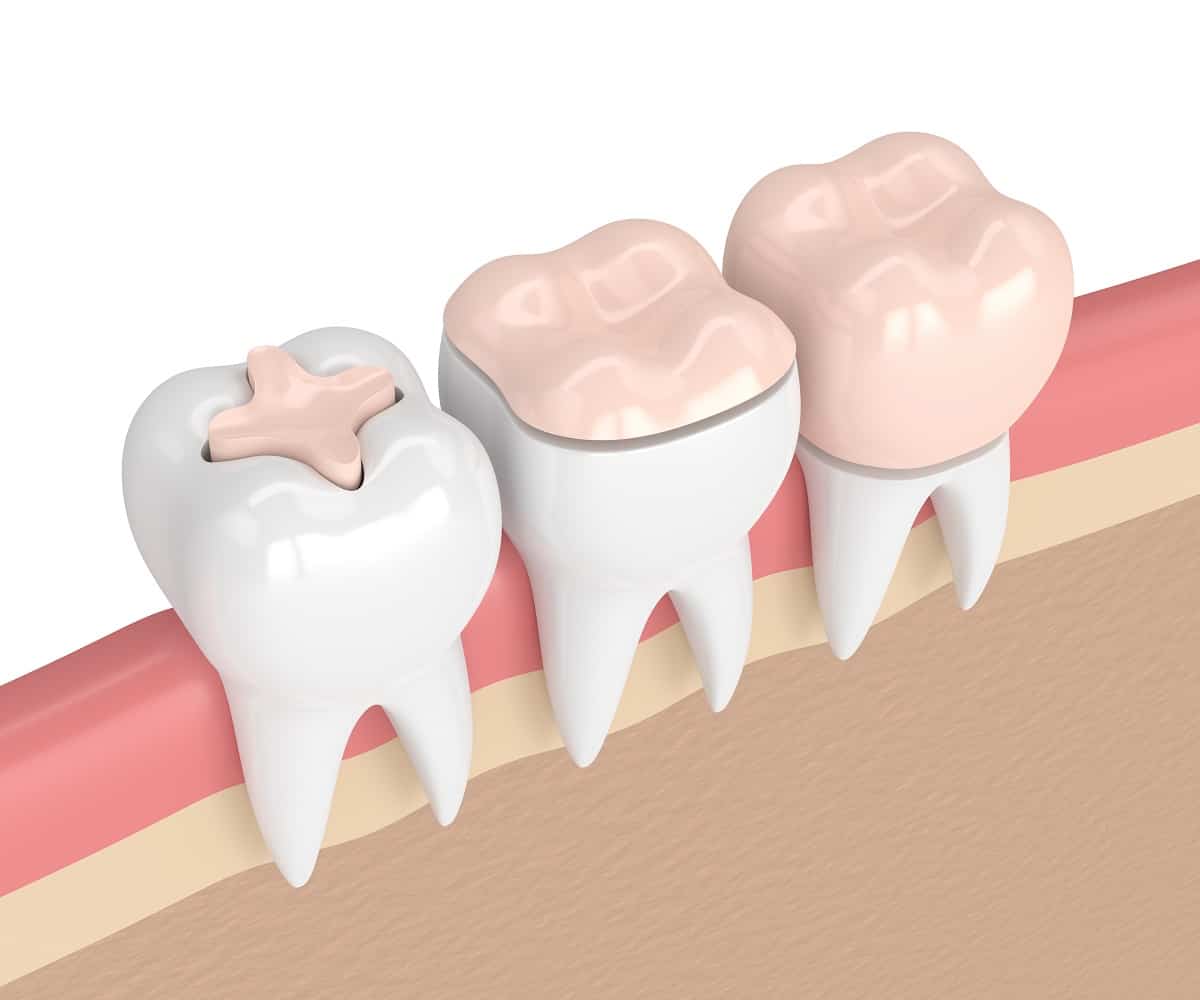 Inlays and Onlays Treatment San Diego Dentist