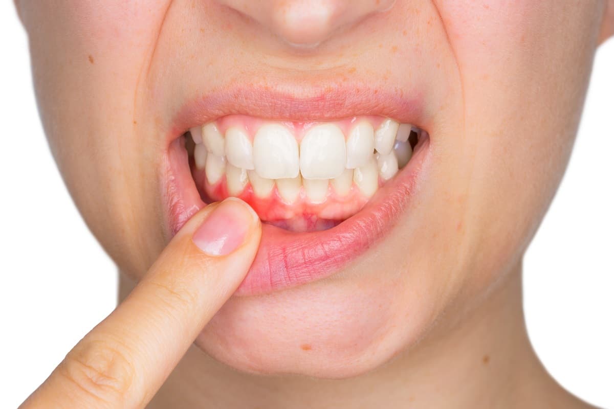 Bleeding Gums Treatment San Diego Dentist