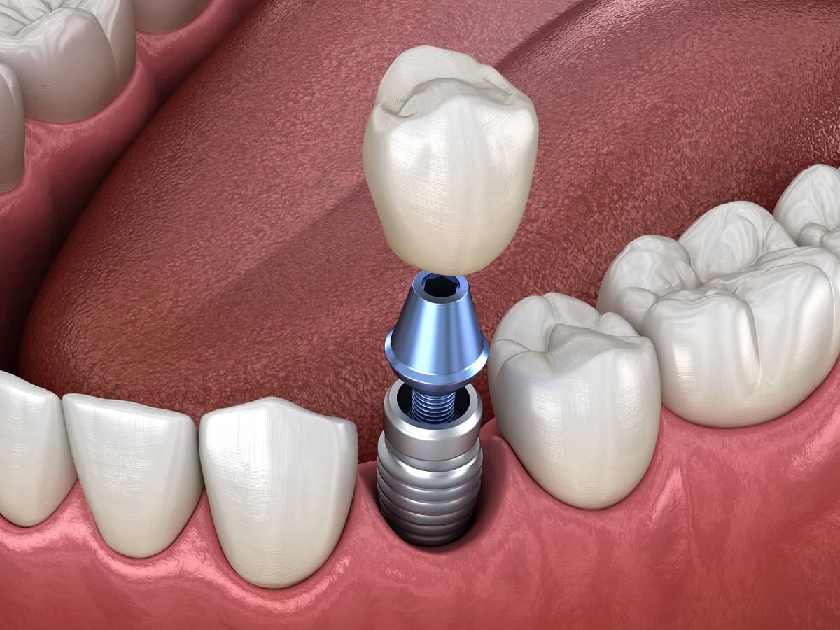 Dental Implants in La Jolla