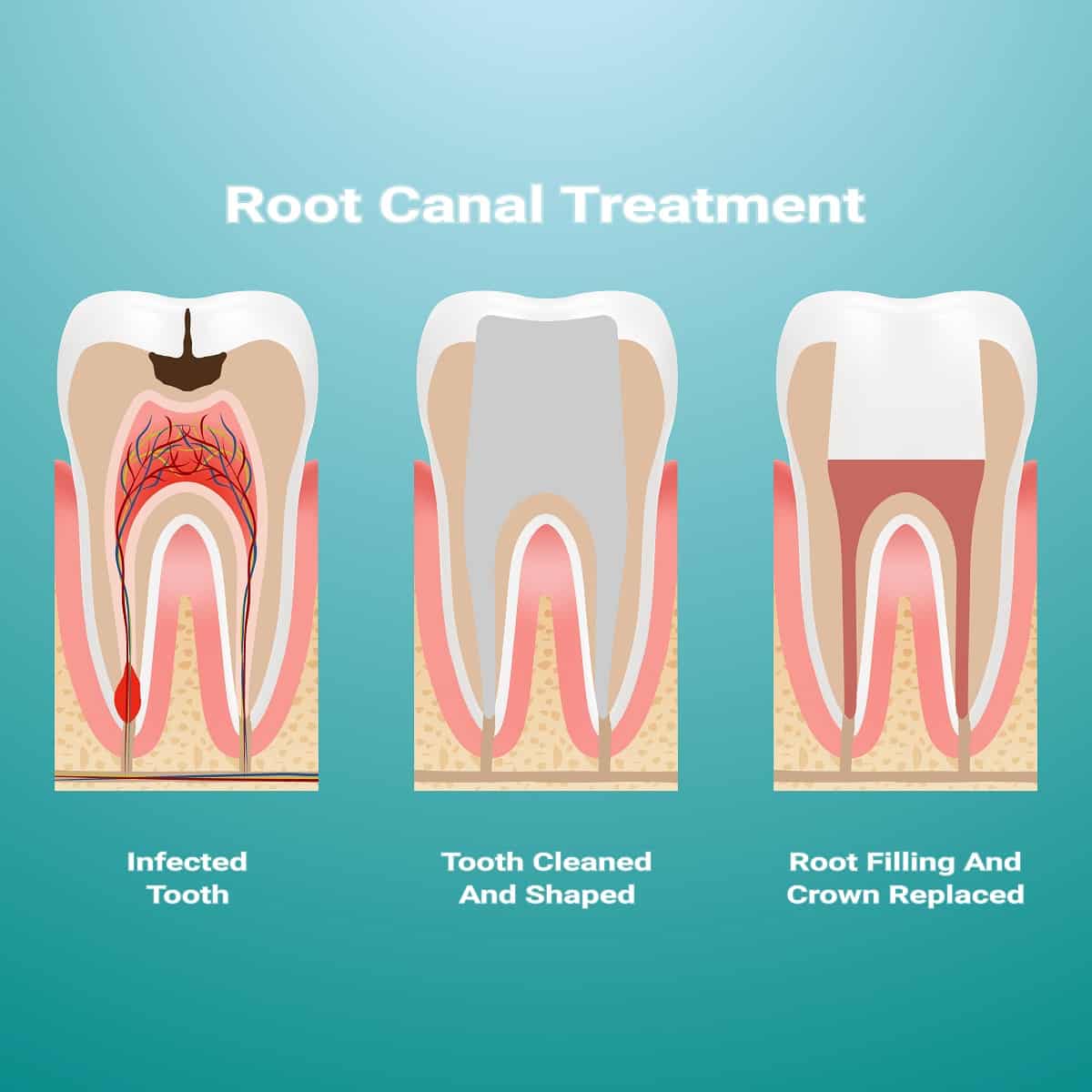 Root Canals La Jolla