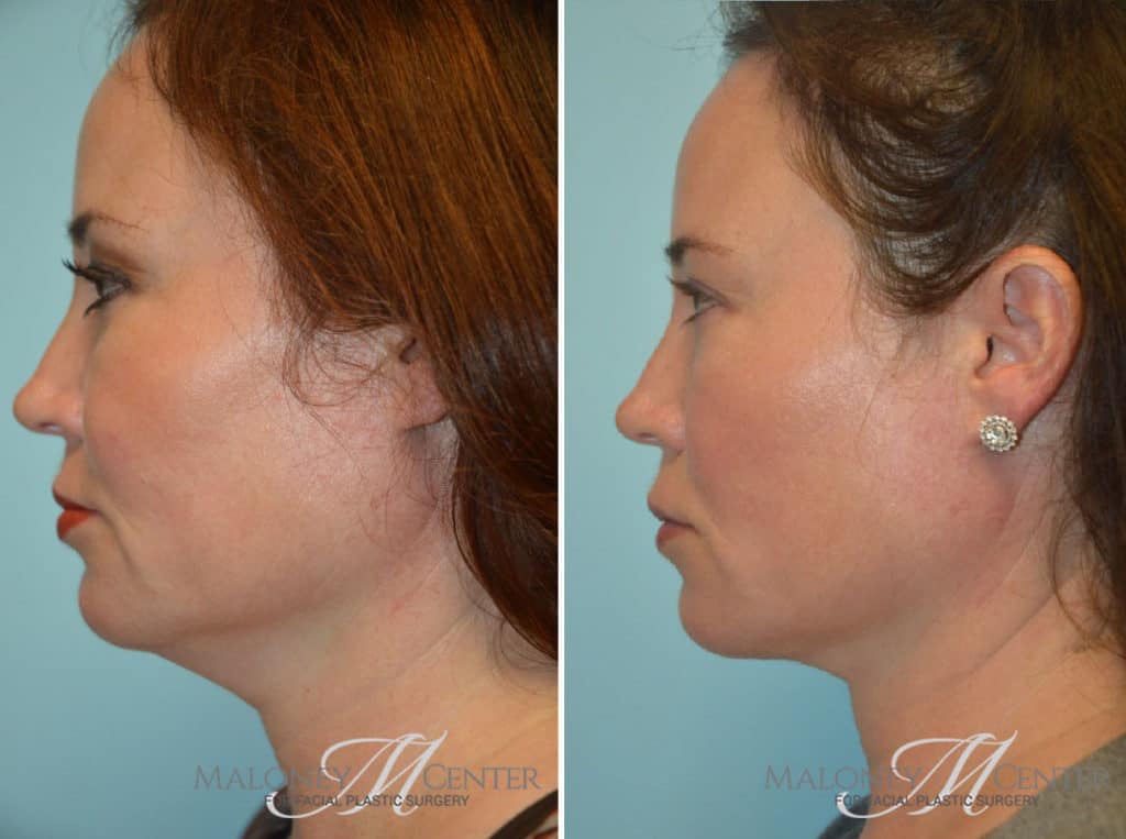 Kybella in Atlanta Maloney Center for Facial Plastic Surgery