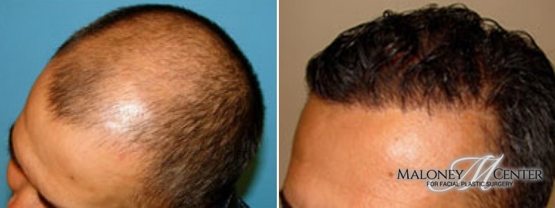 Before & After Hair Restoration Gallery Atlanta, GA