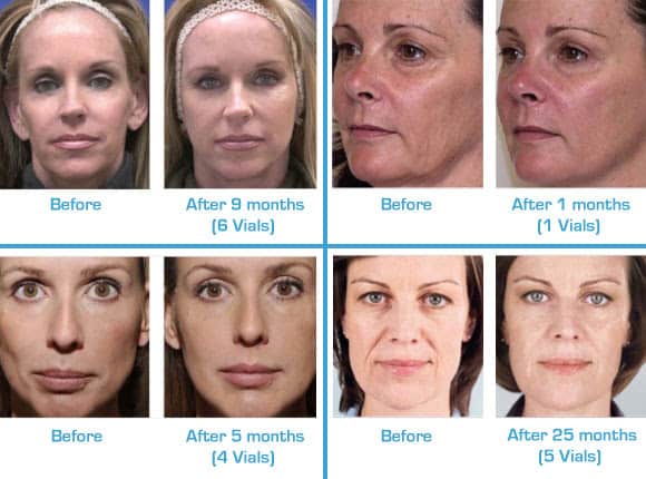 Face lift without surgery