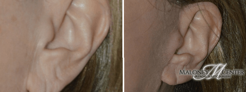 Chao Plastic Surgery - Earlobe filler! It's a perfect, nonsurgical repair  for saggy earlobes. Earrings hanging? Earlobes stretched out? Make an  appointment today! ✨ No downtime. Lasts 1+ years