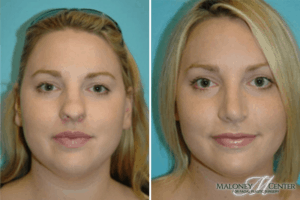 Before and after nose job Atlanta, GA