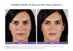 Juvederm Vollure XC before & after 