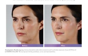 Juvederm fillers in Atlanta at Maloney Center for Facial Plastic Surgery
