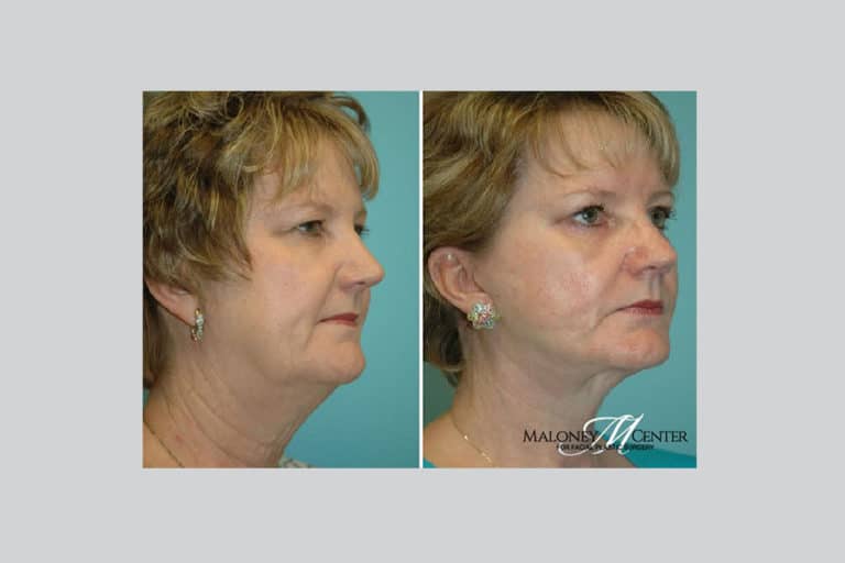 What you need to know about facial fat transfer Maloney Center for