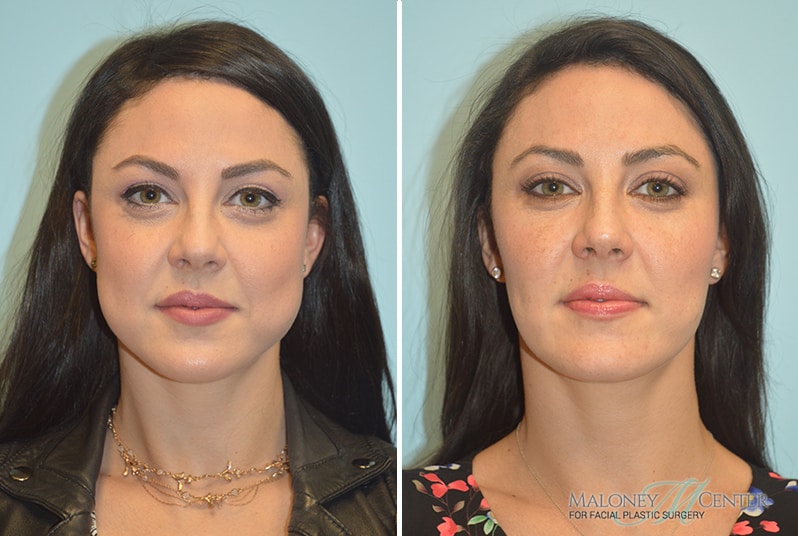 Before & After Buccal Fat Pad Removal Gallery Atlanta
