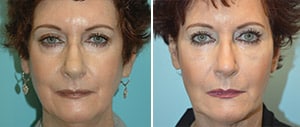 Do You Need Tear Trough Filler or a Blepharoplasty? - Brian S