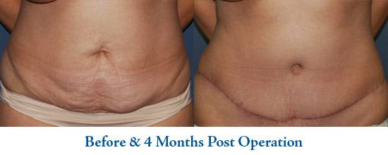 Tummy Tuck Scars - Minneapolis, MN