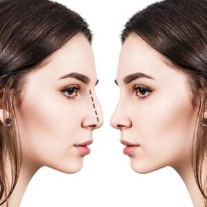 Cosmetic surgery – rhinoplasty in Plymouth, MN