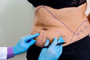 A tummy tuck patient with areas of improvement mapped on their belly before surgery