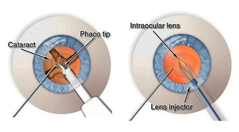 Increased Cataract-Related Complications Seen In Previously Injected Eyes