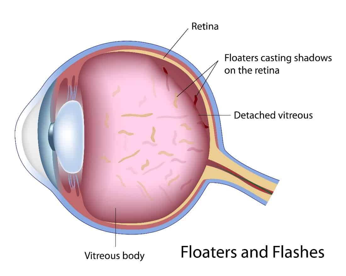 new research on eye floaters