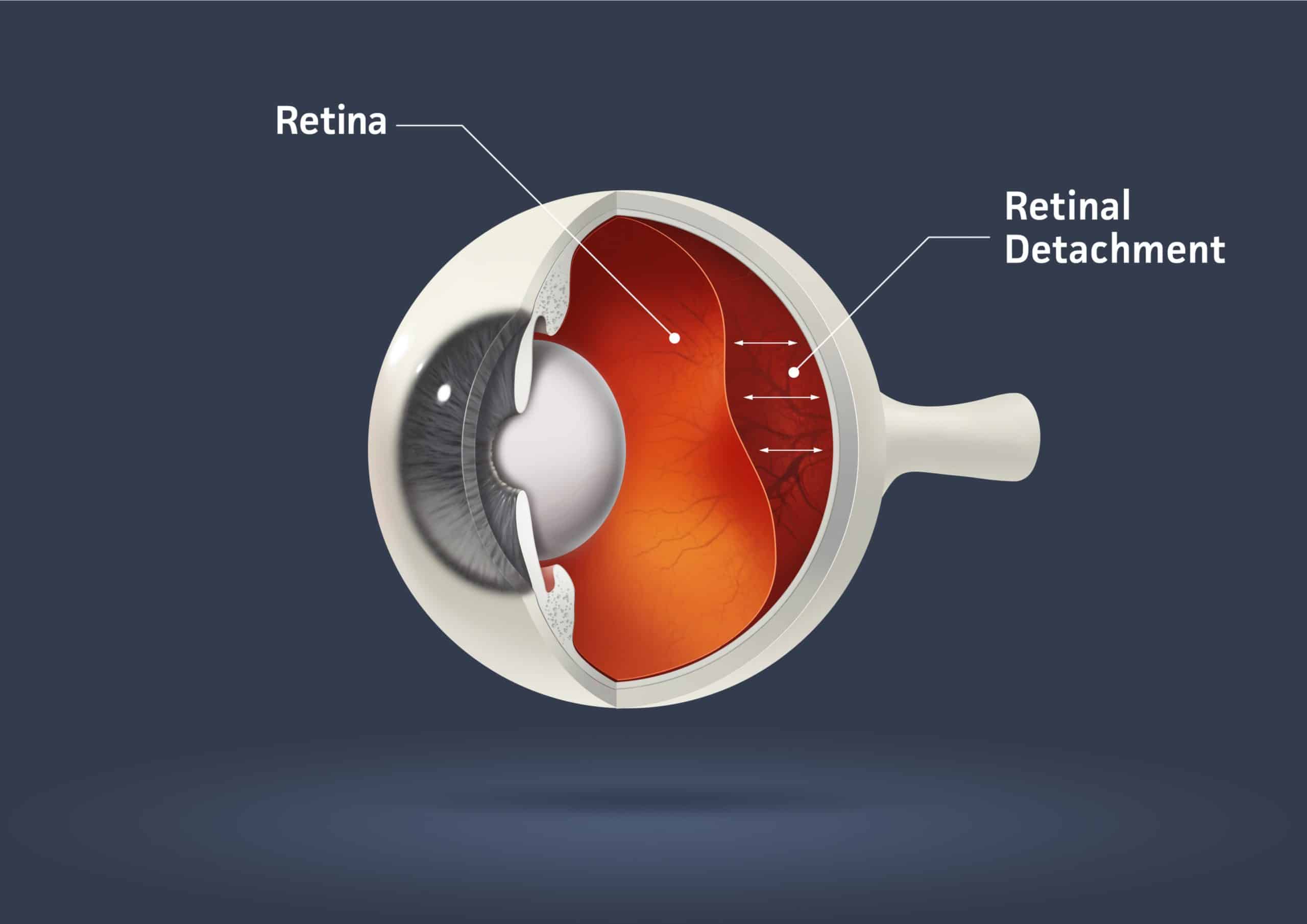 Retinal Detachment Prevention Mittleman Eye West Palm Beach & Jupiter FL
