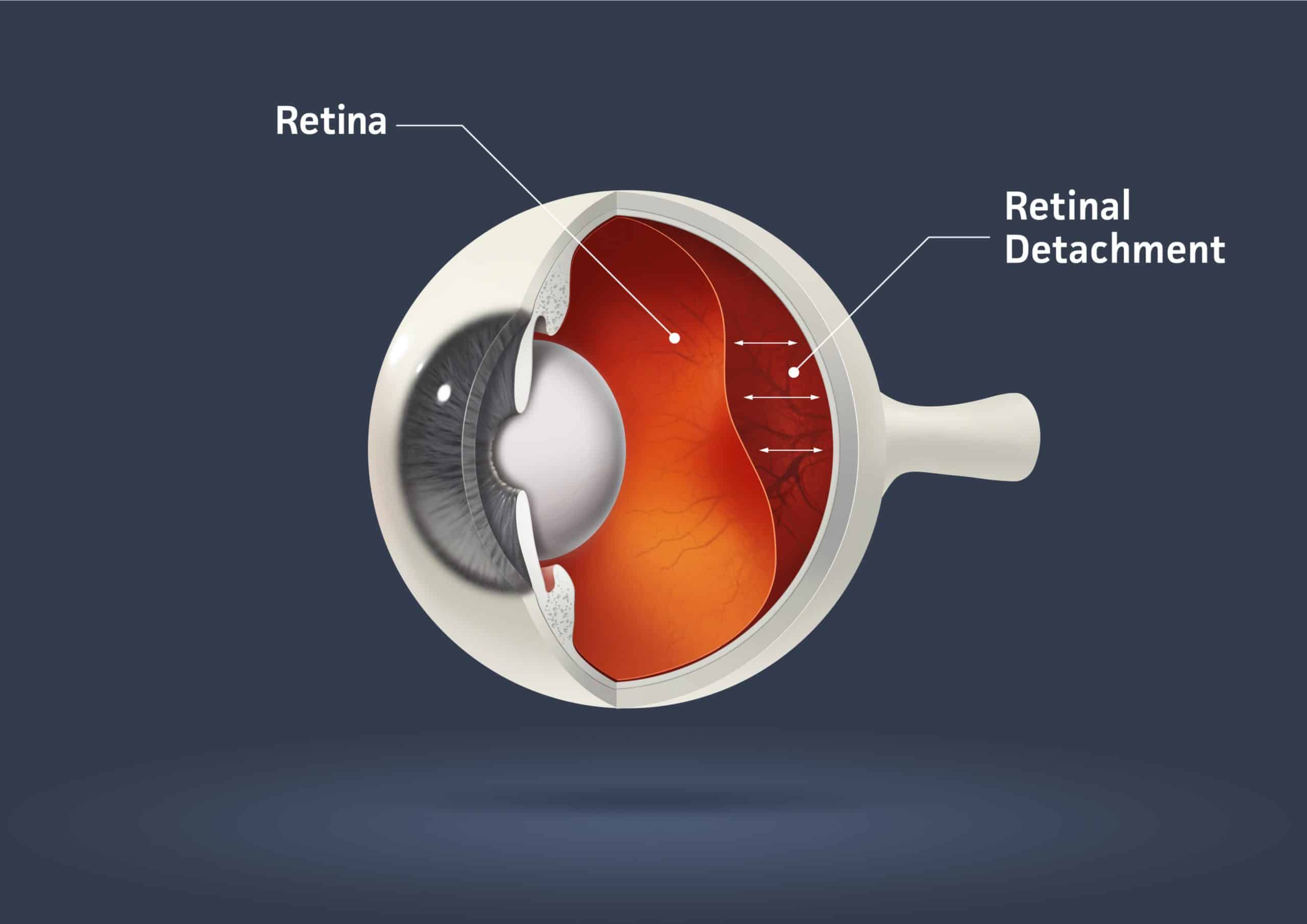 What is Retina in the Eye?