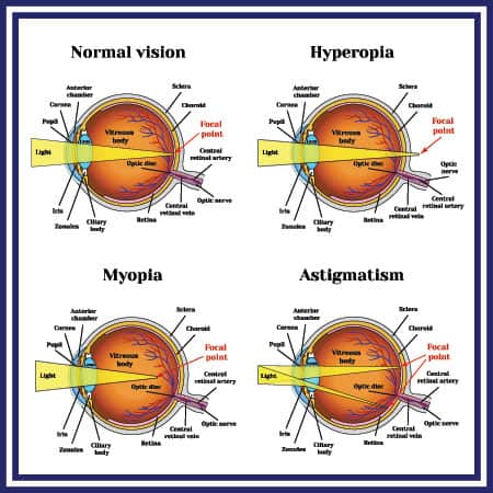 LASIK West Palm Beach - Laser Eye Surgery for Nearsightedness