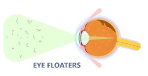 Eye Floaters in Jupiter