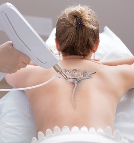 Is Tattoo Removal Good or Bad for you? - Couture Med Spa