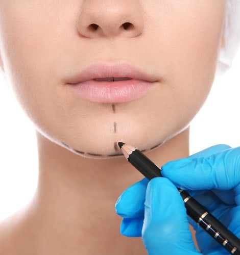 chin augmentation la jolla