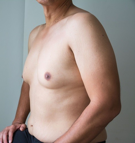 male breast reduction la jolla