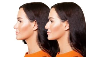 Female Rhinoplasty Coronado