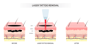 Tattoo removal Coronado