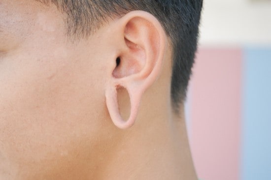 Ear Lobe repair Coronado