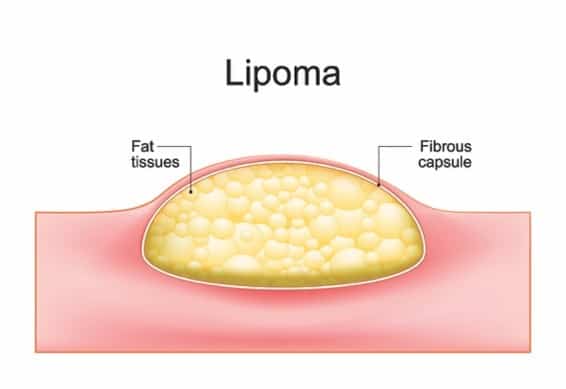 Lipoma Removal and Treatment Coronado