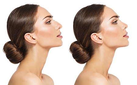 Rhinoplasty in Chula Vista