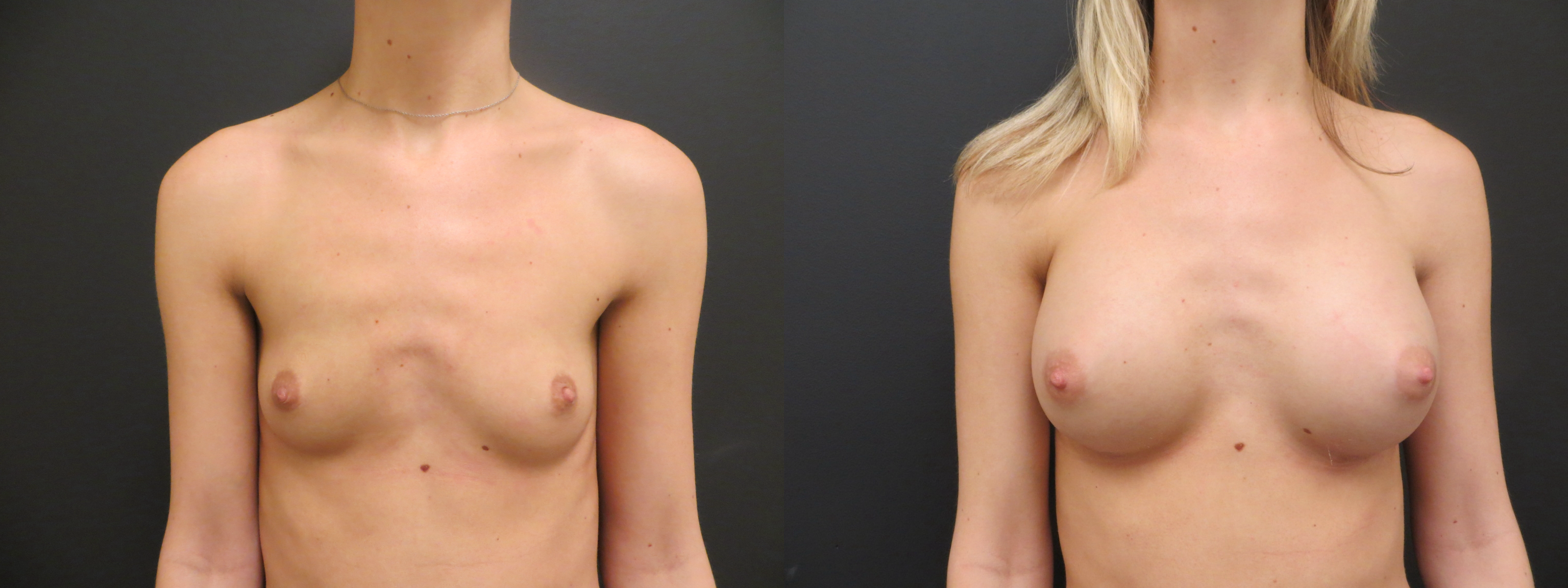 Patient #56 Breast Augmentation