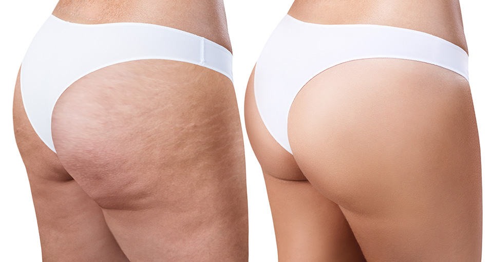 Aveli™ Savannah - Cellulite Reduction Georgia: Long-Lasting